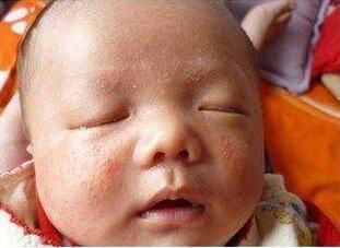 去痱子成人小妙招视频,成人夏日护肤必备！