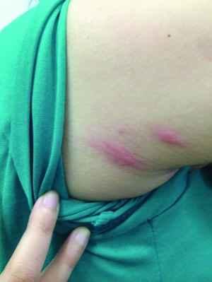 成人怎么去螨虫呢视频,成人如何轻松去除家中螨虫