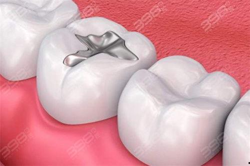 成人补牙流程视频教程